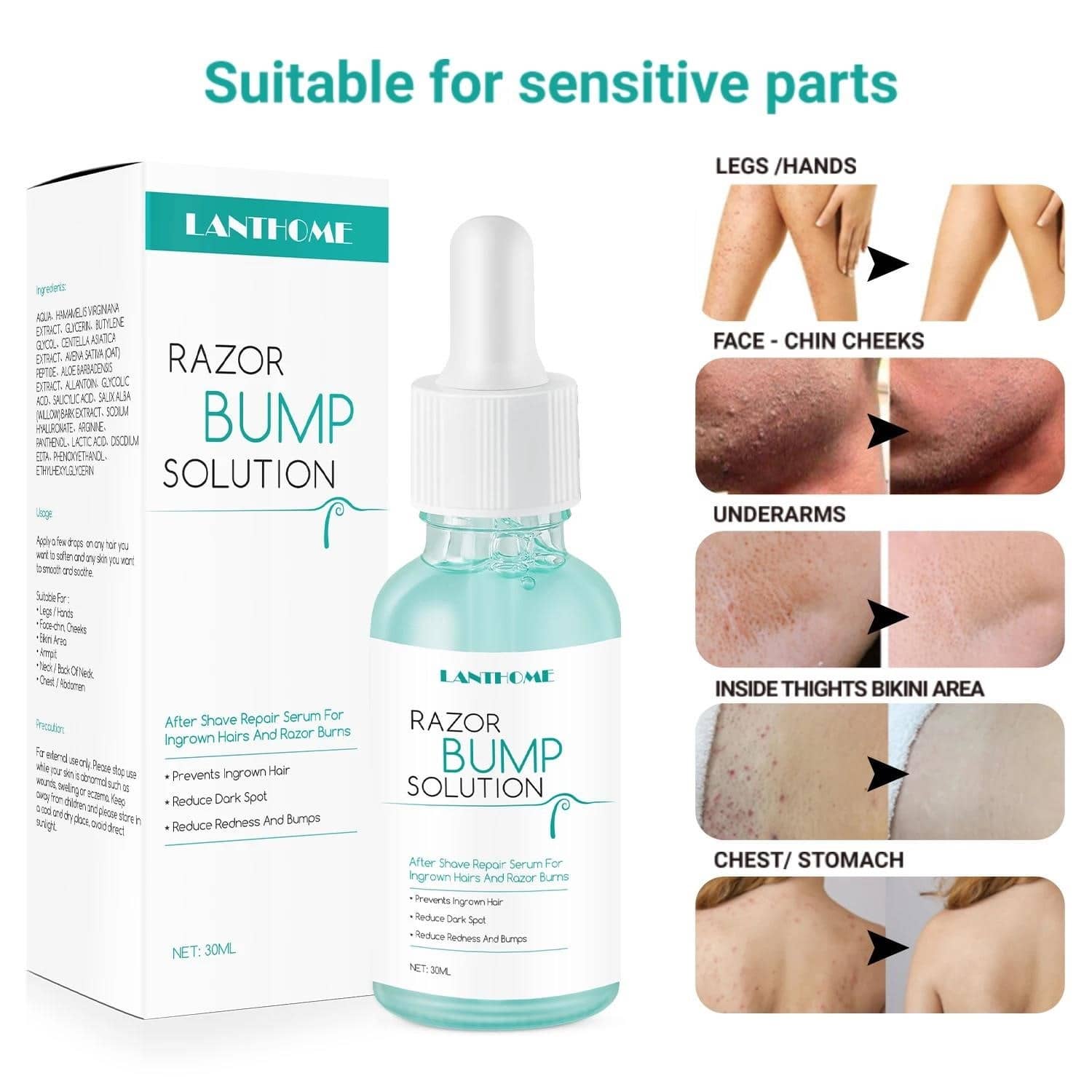 Legendary Razor Bump Solutions Lanthome Razor Bumps Removal Solution For Hair Treatment After Shave ...